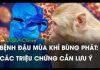 NHỮNG ĐIỀU CẦN BIẾT VỀ BỆNH ĐẬU MÙA KHỈ