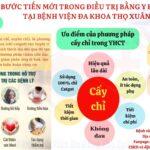 CẤY CHỈ- BƯỚC TIẾN MỚI TRONG ĐIỀU TRỊ Y HỌC CỔ TRUYỀN TẠI BVĐK THỌ XUÂN