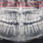 NHỔ RĂNG KHÔN MỌC LỆCH AN TOÀN-KHÔNG ĐAU TẠI BỆNH VIỆN ĐA KHOA HUYỆN THỌ XUÂN.