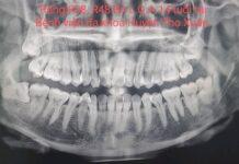 NHỔ RĂNG KHÔN MỌC LỆCH AN TOÀN-KHÔNG ĐAU TẠI BỆNH VIỆN ĐA KHOA HUYỆN THỌ XUÂN.