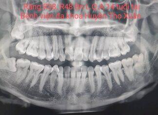 NHỔ RĂNG KHÔN MỌC LỆCH AN TOÀN-KHÔNG ĐAU TẠI BỆNH VIỆN ĐA KHOA HUYỆN THỌ XUÂN.