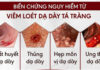 BIẾN CHỨNG VIÊM LOÉT DẠ DÀY – TÁ TRÀNG: NHỮNG ĐIỀU BẠN CẦN BIẾT