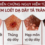BIẾN CHỨNG VIÊM LOÉT DẠ DÀY – TÁ TRÀNG: NHỮNG ĐIỀU BẠN CẦN BIẾT
