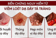BIẾN CHỨNG VIÊM LOÉT DẠ DÀY – TÁ TRÀNG: NHỮNG ĐIỀU BẠN CẦN BIẾT